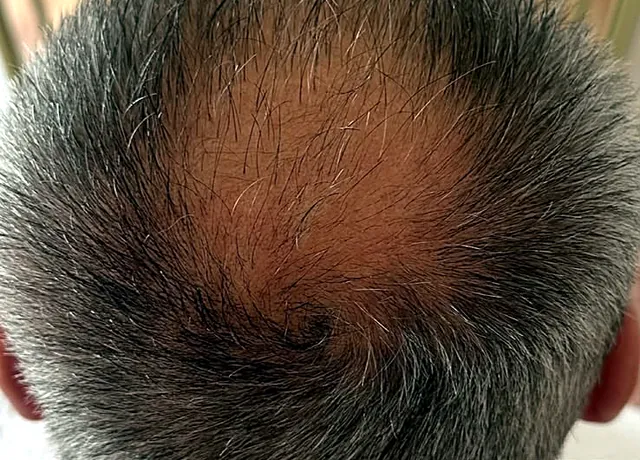 Kopfhaut nach der Cold Plasma Scalp Therapy bei Axéra Beauty
