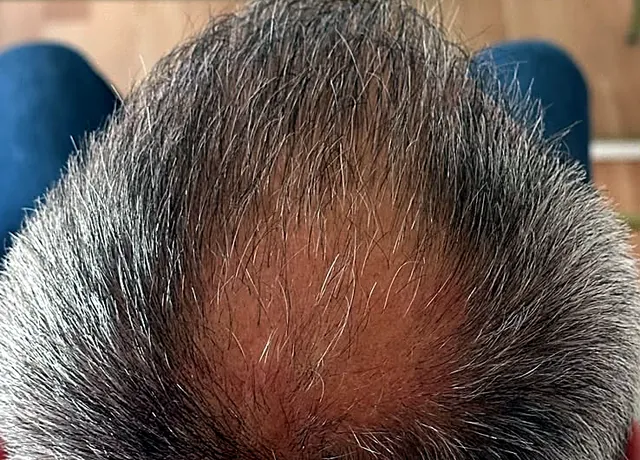 Kopfhaut vor der Cold Plasma Scalp Therapy